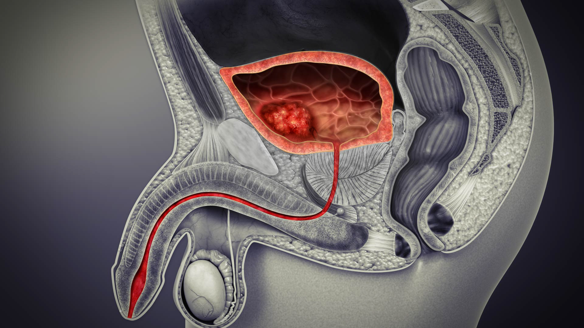 膀胱がん | きぼうの杜クリニック